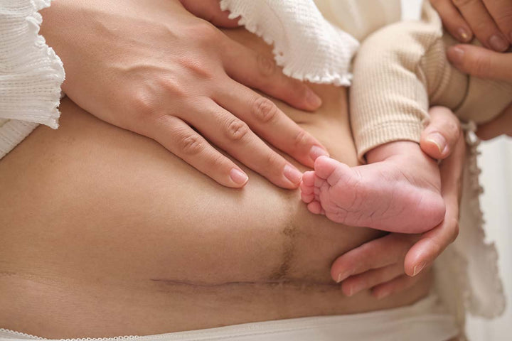 What to Expect from a C-section